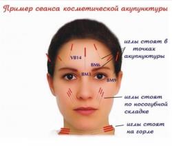 Аккурунктурная пластика лица